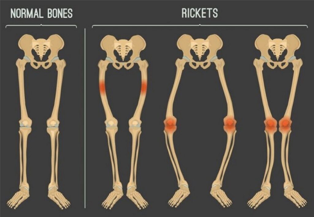 Vitamin D  - Rickets